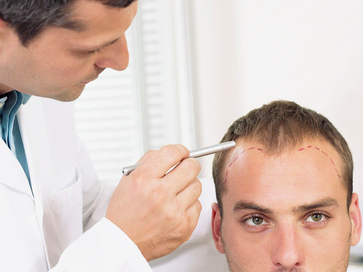 Hair Transplant